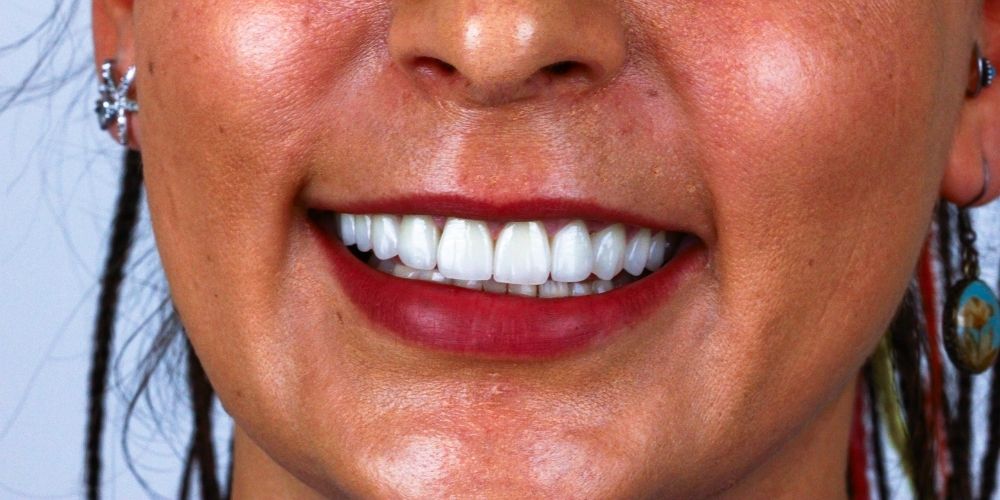 Teeth Whitening in Istanbul | Istanbul Beyoğlu Cihangir Dental Clinic