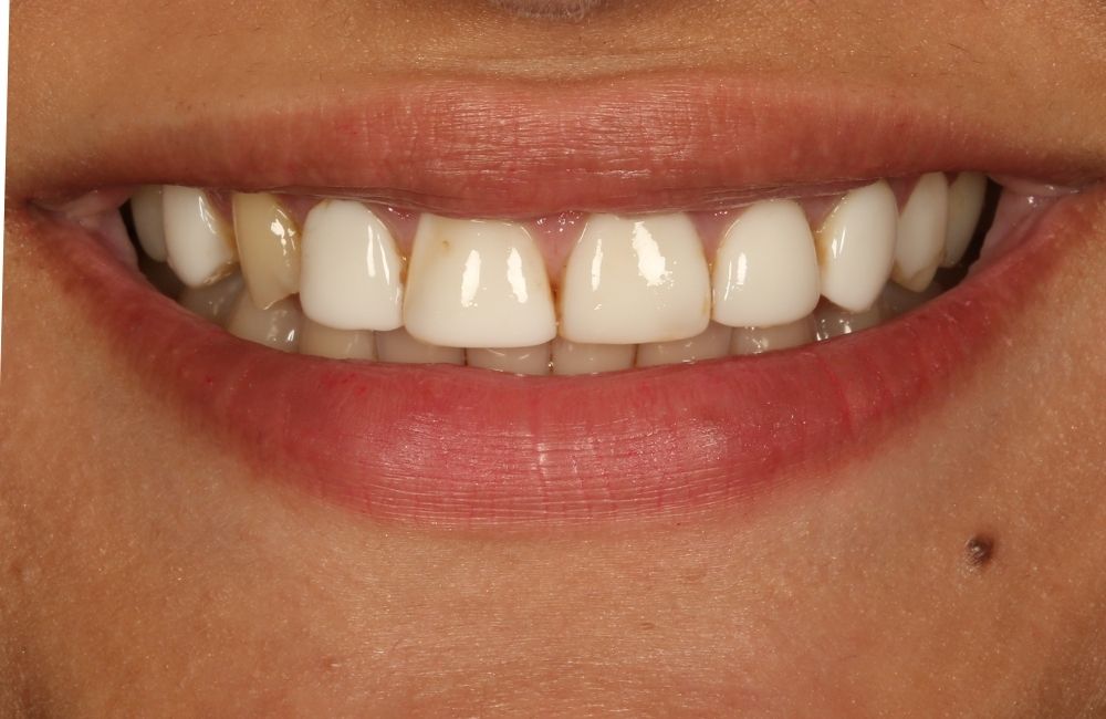 Before treatment smile