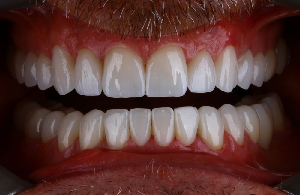 After treatment smile