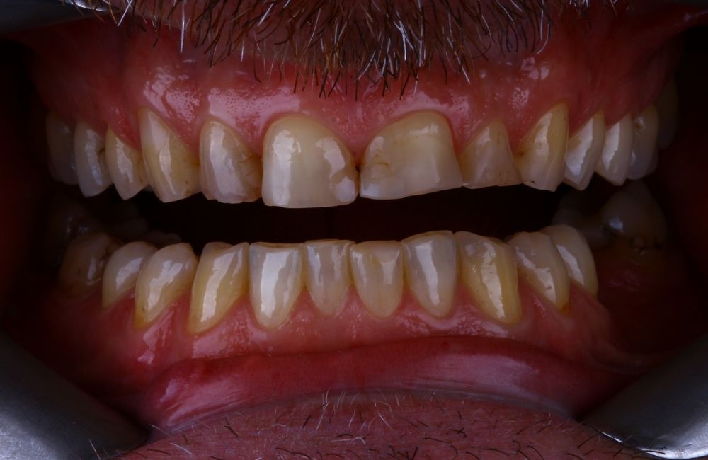 Before treatment smile