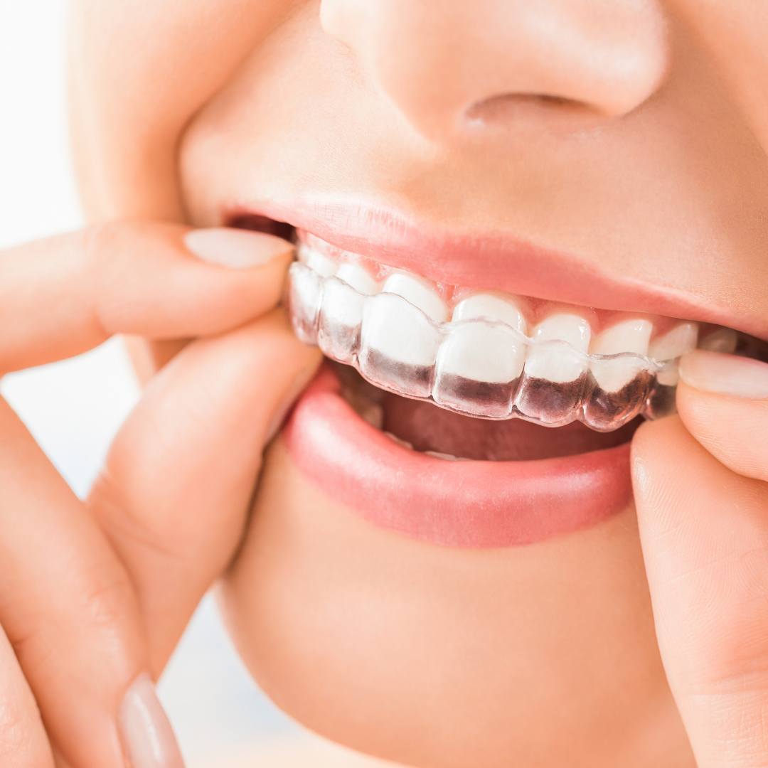 Invisalign advantages