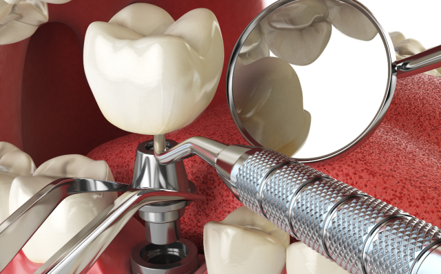 Dental implants